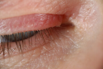 Fototapeta premium Person trying to open eye, red spot on eyelid, eye infection