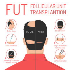 FUT hair transplantation process vector isolated. Follicular unit transplantation. Baldness problem, surgical treatment. Graft implantation, medical infographic.