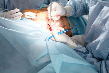 A surgeon with an assistant operates on the female breast, mammoplasty, breast oncology.