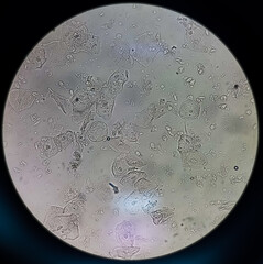 Epithelial cells with bacteria in patient urine (urinary tract infections), analyze by microscope,...