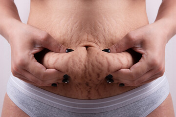 belly with stretch marks, woman shows problem areas with stretch marks