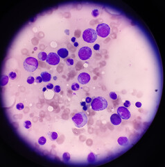 Megakaryocytes in the hematopoietic compartment of the red bone marrow. Acute Lymphoblastic...