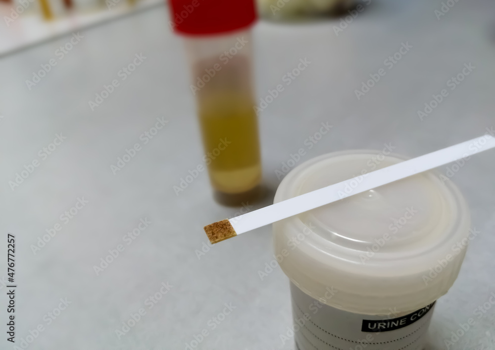 Sticker testing strip and sample container isolated for urine glucose test, showing abnormal result. urine s