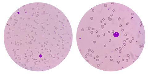College of two Photomicrograph showing Leuco-erythroblastic anemia.