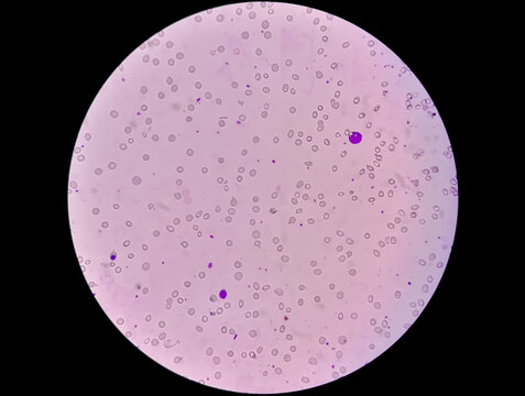 Photomicrograph of Leucoerythroblastic anemia. 40X