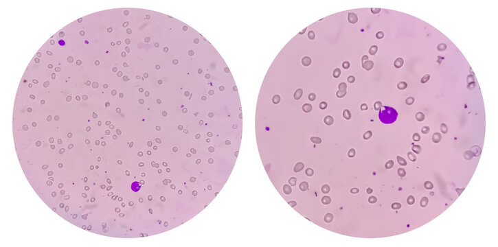 College of two Photomicrograph showing Leuco-erythroblastic anemia.