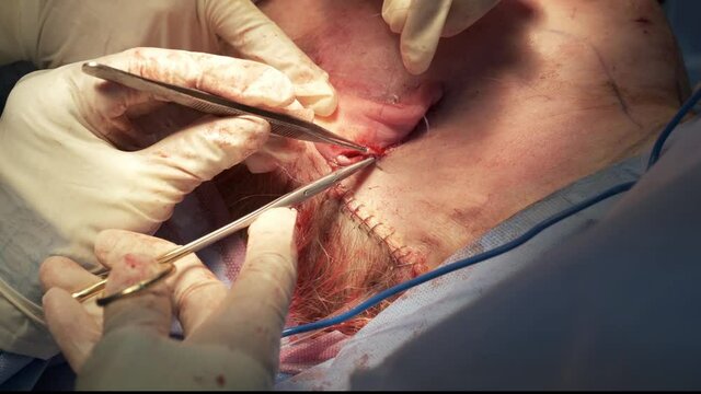 Plastic surgical operation to lift the neck and remove the second chin. The doctor applies stitches after surgery