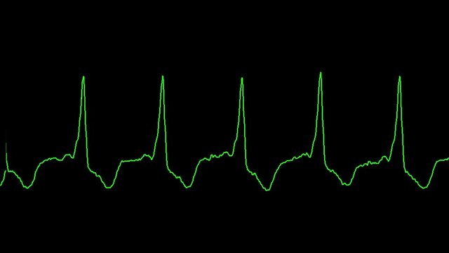ecg shows pulse wolf parkinsons white syndrome from patient at cardiology department 