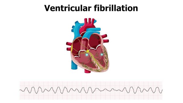 Ventricular Fibrillation Images – Browse 5,871 Stock Photos, Vectors, and  Video | Adobe Stock
