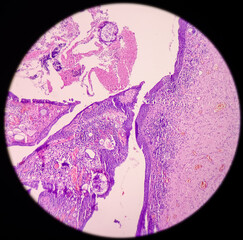 Nasal mass tissues: Rhinosporidiosis, microscopic show large thick walled sporangia with many endospores accompanied by a mixed inflammatory infiltrate. no malignancy seen.