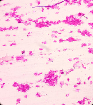 High Vaginal Swab (HVS): gram stained microscopic view of epithelial cells with gram positive Diplococci bacteria and few gram negative rods shape bacillus, Streptococcus, Staphylococcus