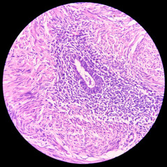 Uterus wall: Proliferative phase adenomyosis, under light microscope show proliferative phase in...