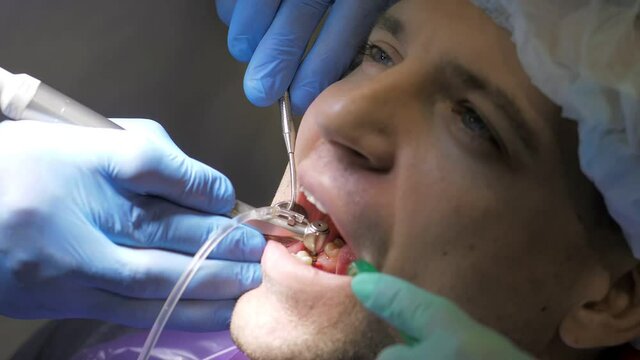 Two doctors in gloves install a dental implant.Restoration of missing teeth with an implant.Installation of veneers in modern dentistry for a young man.The concept of dentistry and dental care.Closeup
