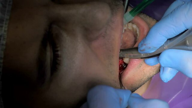 Two doctors in gloves install a dental implant.Restoration of missing teeth with an implant.Installation of veneers in modern dentistry for a young man.The concept of dentistry and dental care.Closeup