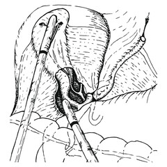 Anatomical drawing of a laparoscopic cholecystectomy. Black and white vector
