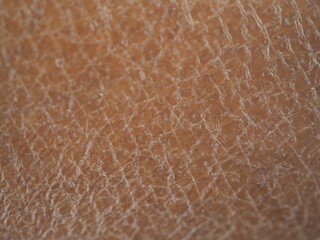 Texture of human skin epidermis with flaky and cracked particles. closeup photo, blurred.