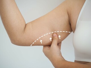 Asian woman grabbing skin on her upper arm with the drawing arrows, Lose weight and liposuction cellulite removal concept, on white background. closeup photo, blurred. - obrazy, fototapety, plakaty