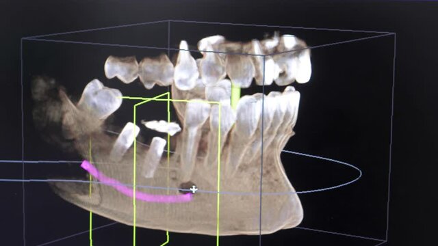 Close-up 3d model of X-ray images of the patient's jaw and teeth on the monitor, modern dentistry. MRI of the jaw in a modern dental clinic. Installation of a dental implant.The concept of dental care