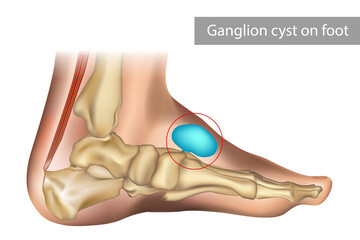 Medical vector illustration of ganglion foot cyst with bones. Big ganglion cysts,a sac of jelly like fluid,is on the foot of man put - obrazy, fototapety, plakaty