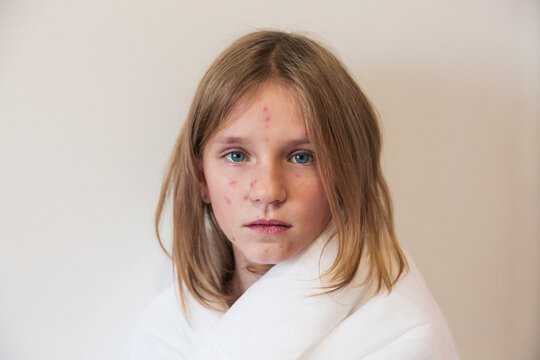 Cute little girl with chickenpox at home. Varicella zoster virus.