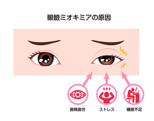 眼瞼ミオキミア（瞼のピクピクした痙攣) の原因 ベクターイラスト