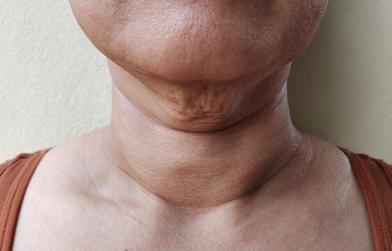 close up portrait of a layered under the neck, problem adipose hanging of woman.