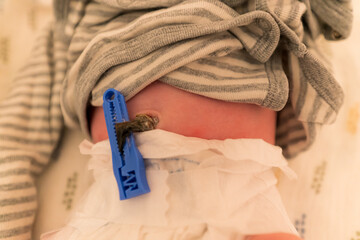 Nabelschnur eines Babys kurz vor dem Abfallen