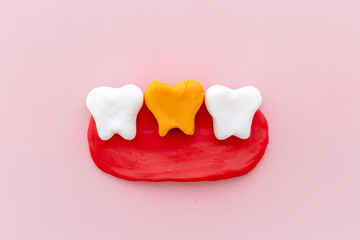 Dental health concept. Teeth models with caries or plaque