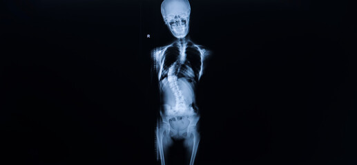 A photo of plain radiograph on dark background in hospital. The film use for diagnosis the illness of patient.Medical concept.whole spine x-ray showing a patient with adolescent idiopathic scoliosis.