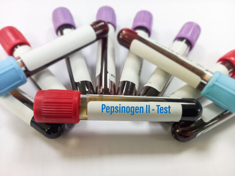 Blood sample tube for Pepsinogen II test. To diagnosis Gastric cancer with medical laboratory background