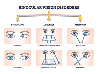 Binocular vision disorders with all eye defect examples outline diagram. Labeled educational anatomical strabismus, vergence and amblyopia division vector illustration. Medical sight health problems. - obrazy, fototapety, plakaty