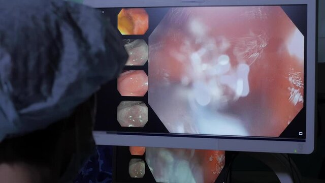 Monitor screen of endoscopy removal of polyp in intestine, Rear view of endoscopist surgeon doing endoscopic polypectomy