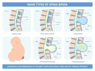 Spina bifida Pregnancy non invasive neural tube gene AFP NTD infant cord folate folic acid serum level sacral dimple child Lumbar birth NIPT test fetus born baby spine blood fluid villus alpha