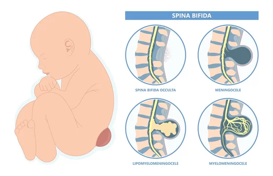 spina bifida occulta dimple