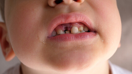 Little boy showing his teeth