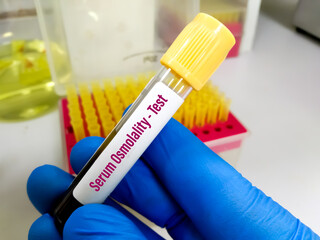 Serum Osmolarity - Test with blood sample at medical laboratory.