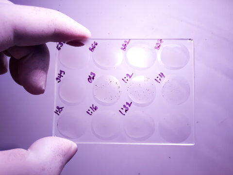 RPR, VDRL, Syphilis test glass slide agglutination method. showing reactive and nonreactive result. To diagnosis Syphilis and Gonorrhea, STD.