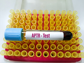 Blood sample tube for Activated Partial Thromboplastin Ratio (APTR) test at medical laboratory. To...