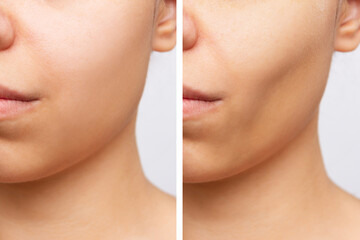Cropped shot of young caucasian woman before and after plastic surgery buccal fat pad removal on a...