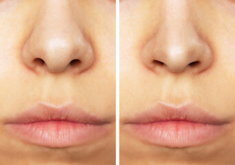 A close-up of woman's nose before and after rhinoplasty. The result of cosmetic plastic surgery on the nose. Beauty concept