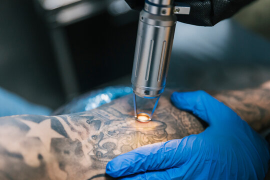 Tattoo master removing tattoo on arm of client