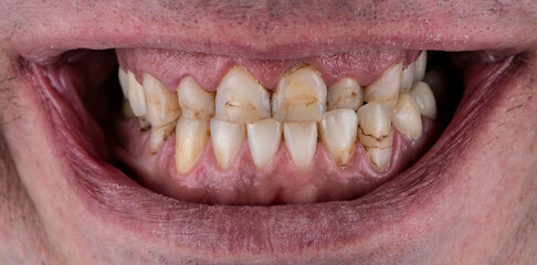 press ceramic crowns and veneers natural color