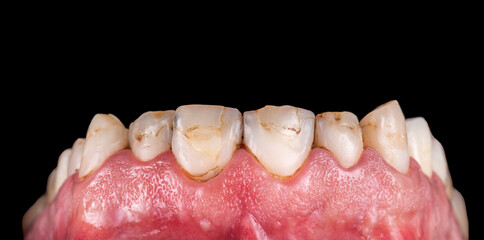 press ceramic crowns and veneers natural color