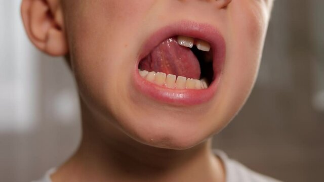 A close-up of a little boy's face with his mouth open, he shows his changing teeth.