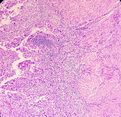 Uterus wall: Simple endometrial hyperplasia, show revealing features of simple endometrial hyperplasia, no malignant cells present.
