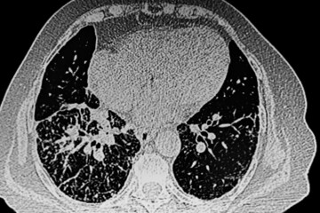 Pneumonia lung infection X- Ray