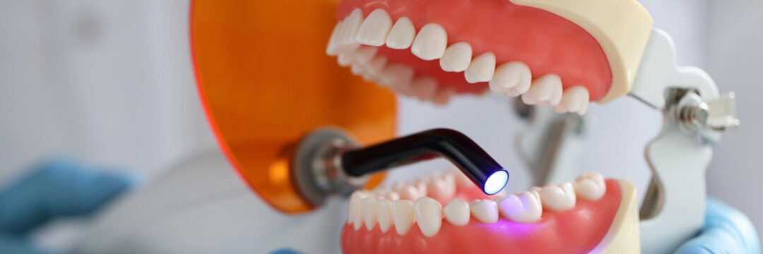 Doctor holds jaw and dental UV lamp to fill dental jaw