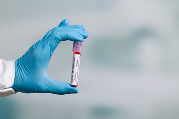 Close up of hands in medical gloves holding a test tube after virus analysis with omicron result...
