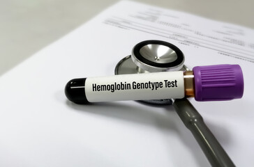 Blood sample isolated for Hemoglobin Genotype test. Diagnosis for hereditary anemia and...