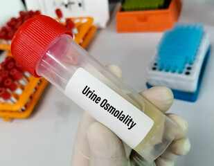 Scientist hold urine container with sample for Urine osmolality test.